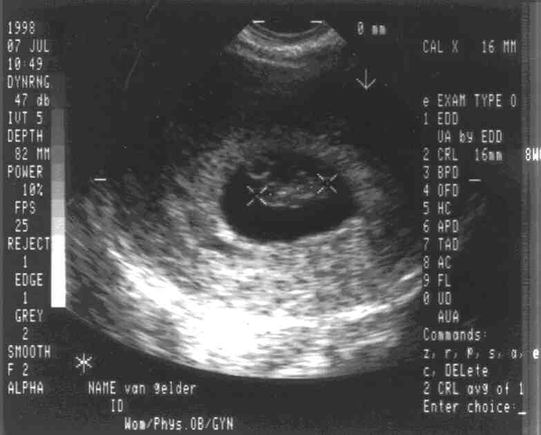 Sonogram